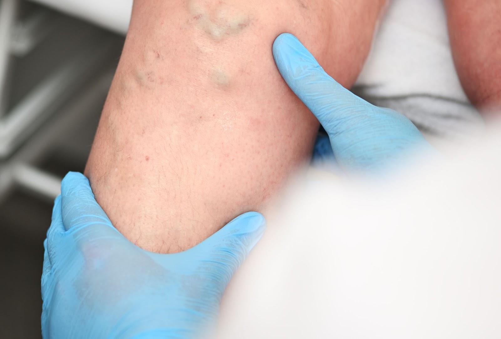 Removing Varicose Veins: How Does it Work?
