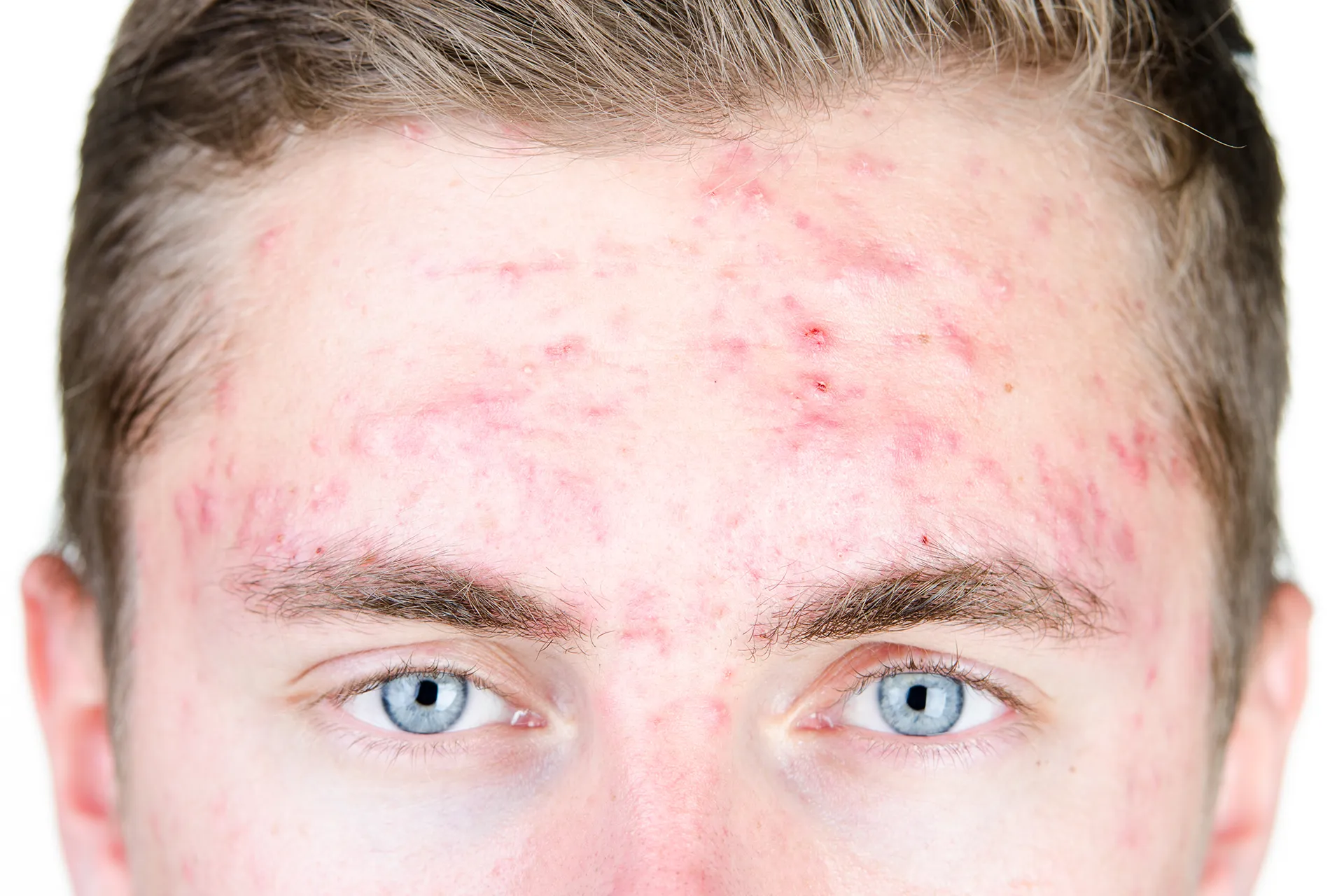 Front view of a person with prominent acne on the forehead and cheeks.