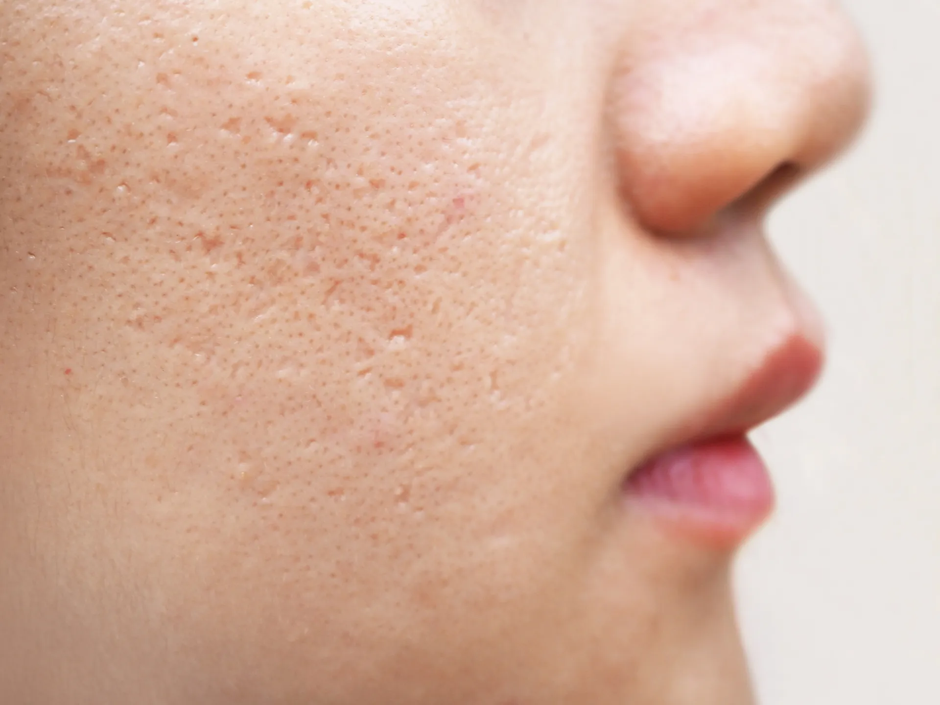 Close-up view of a person's cheek showing skin texture with visible pores.