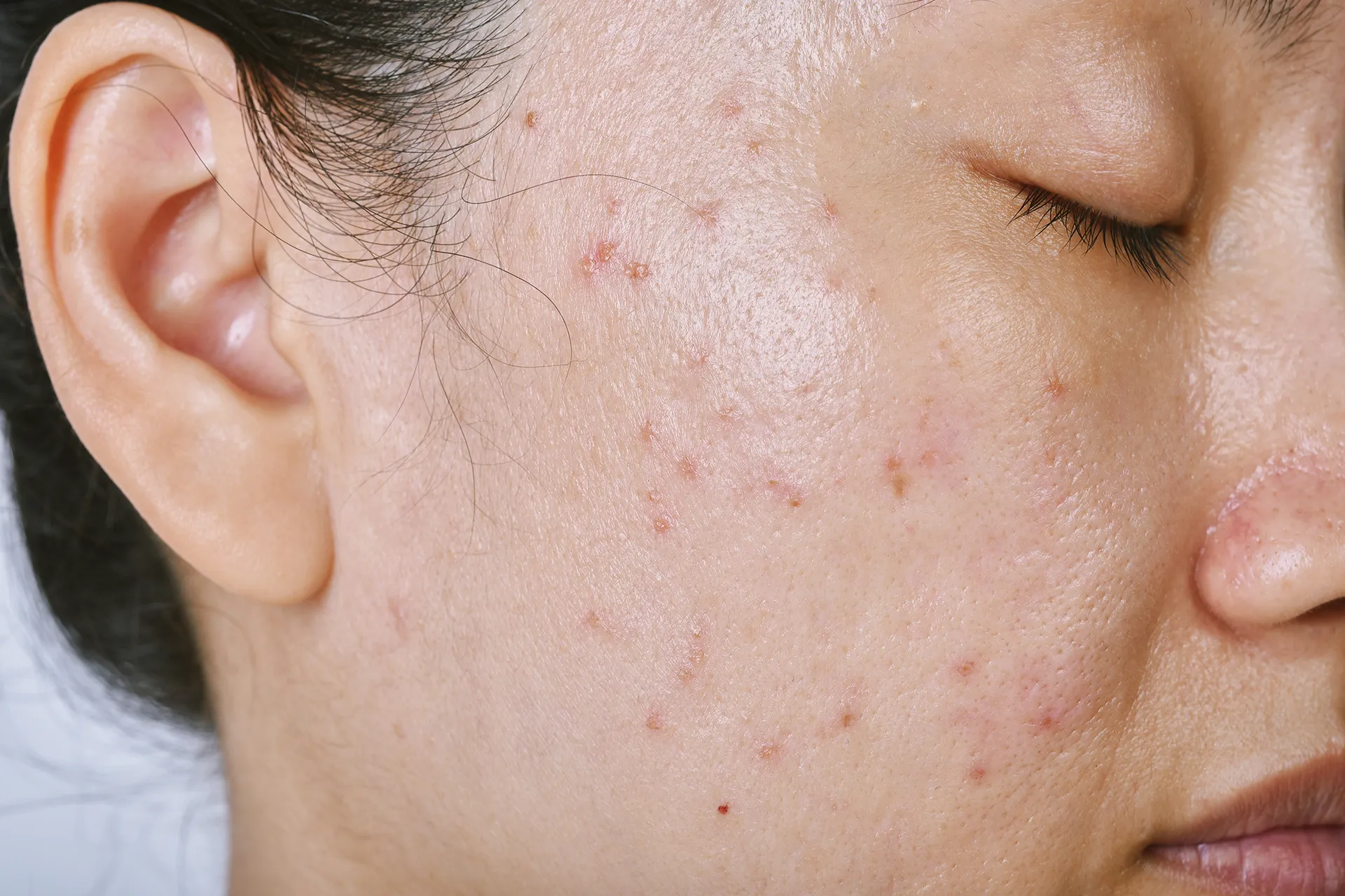 Close-up of acne on a woman's cheek, highlighting skin imperfections.