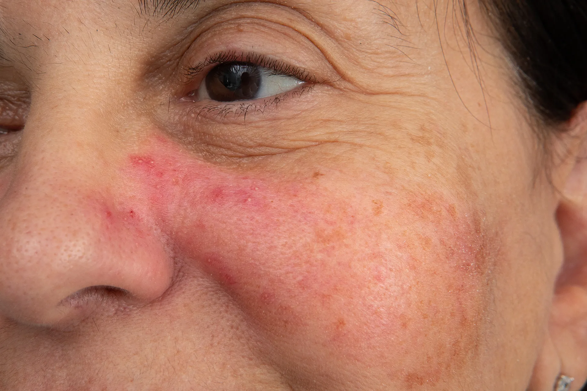 Close-up of a woman's cheek displaying rosacea and skin texture, highlighting redness.