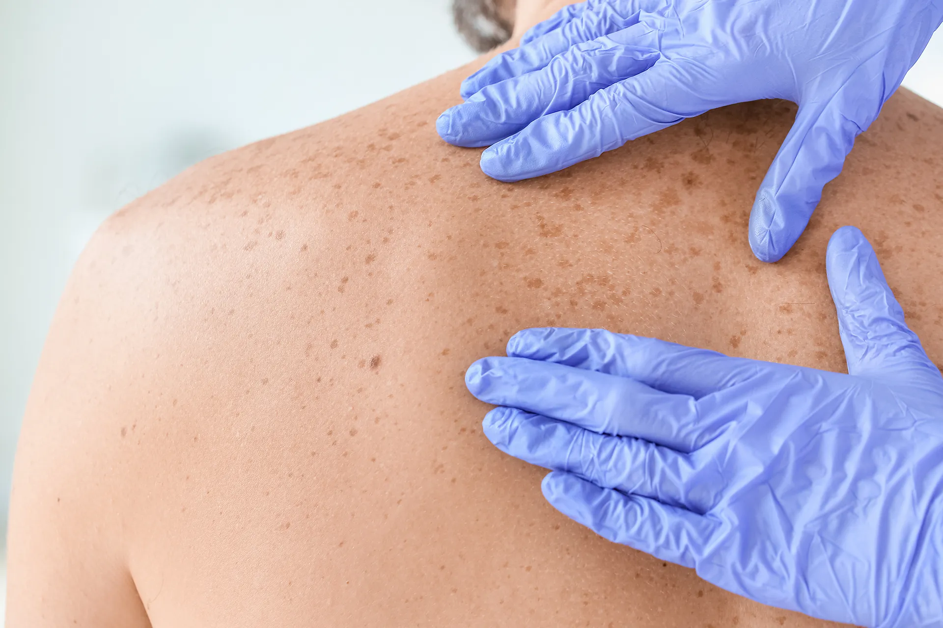 Dermatologist examining a man’s back with skin spots, wearing protective gloves.