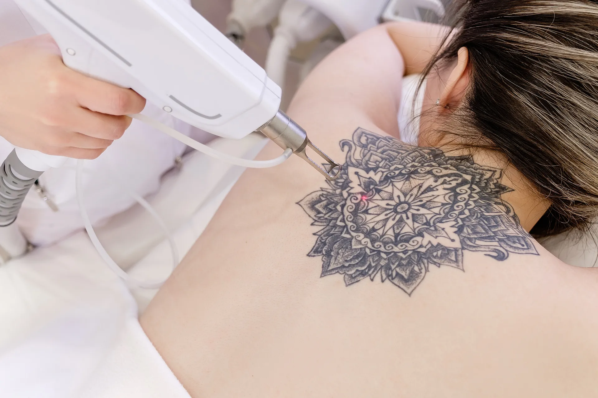 A person receiving laser tattoo removal treatment on their back.