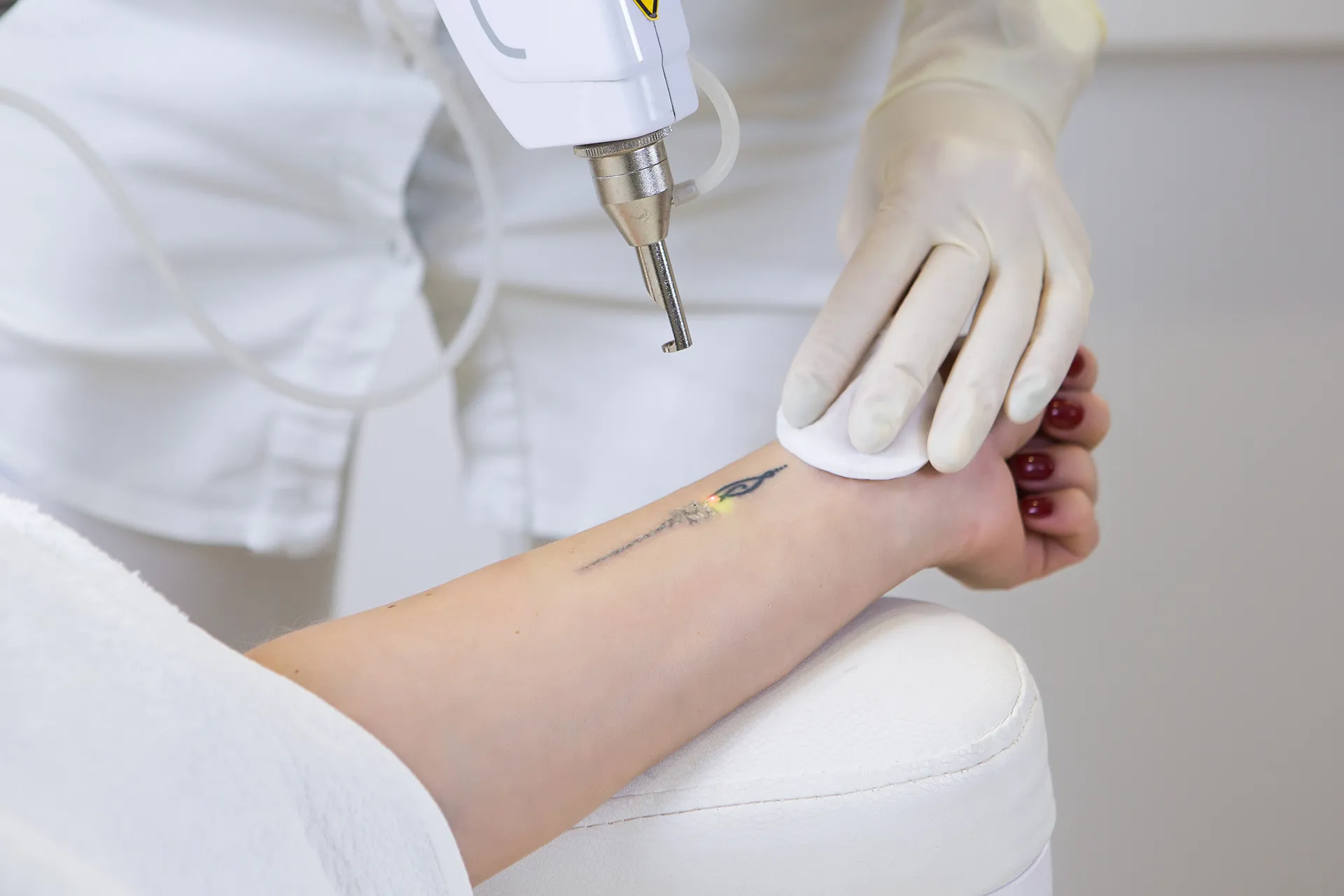 Professional applying laser treatment to a tattoo on a woman’s wrist, wearing gloves.
