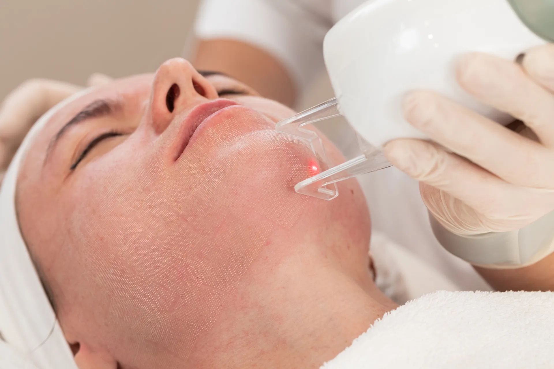 Woman undergoing a skincare procedure with a laser device being applied to her face.