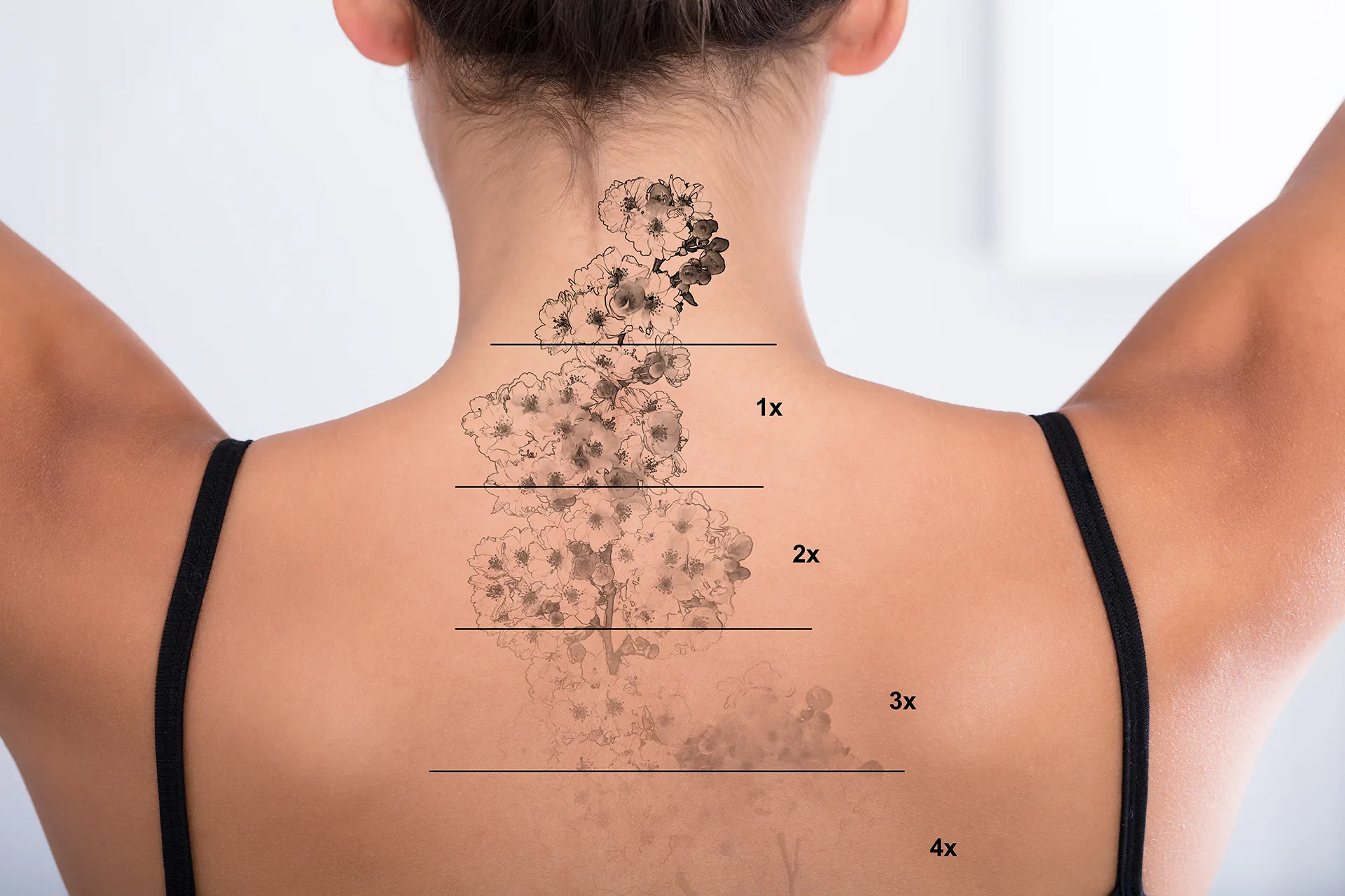 A view of a person’s back showing a floral tattoo fading in stages, labeled with numbers indicating the levels of fading.
