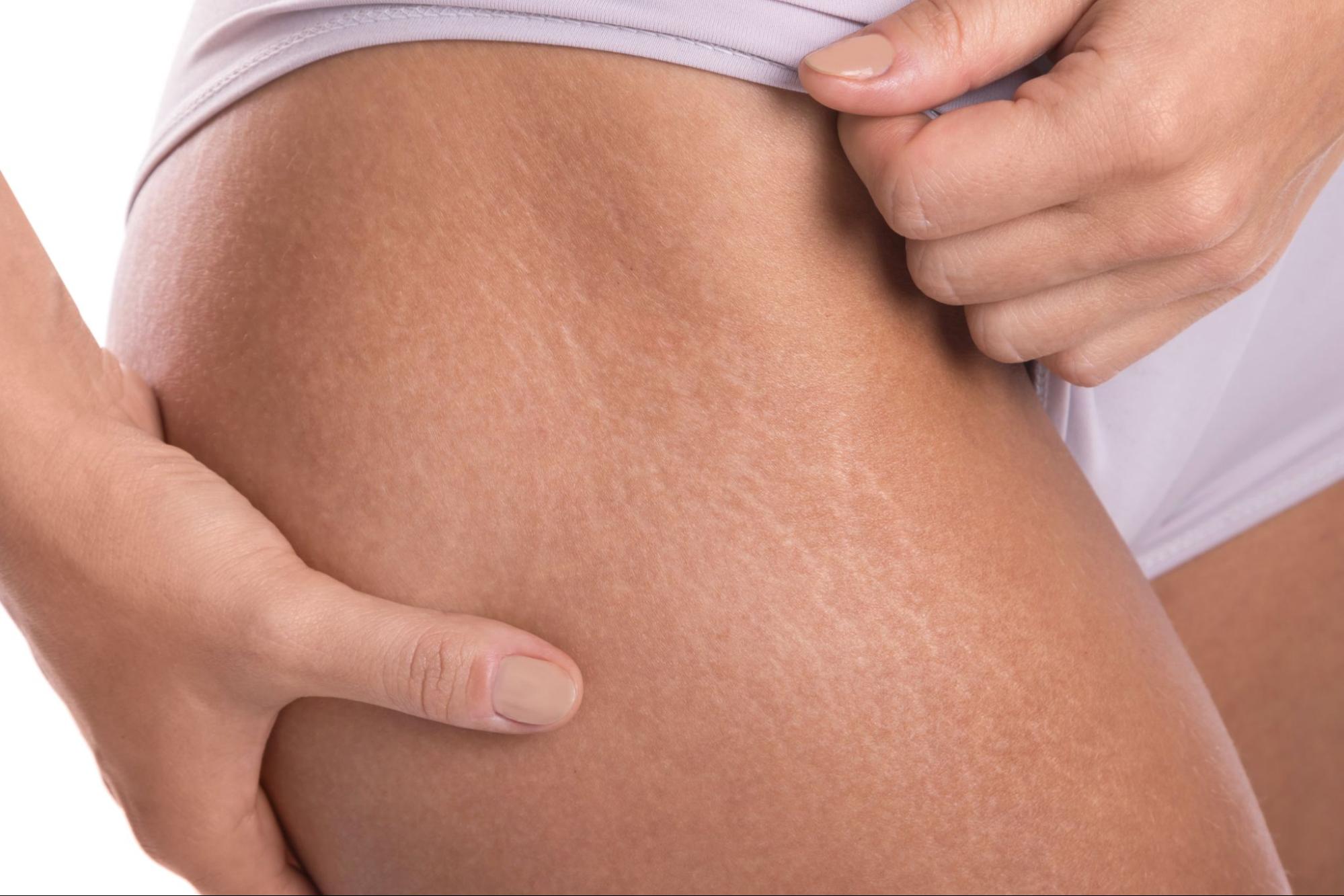 How to Remove Stretch Marks Permanently?